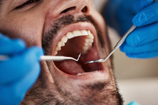 Best Urgent Care for Lost Fillings or Crowns in Maggie Valley, NC